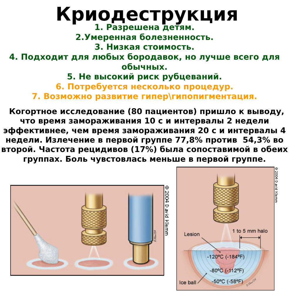 криодеструкция бородавок