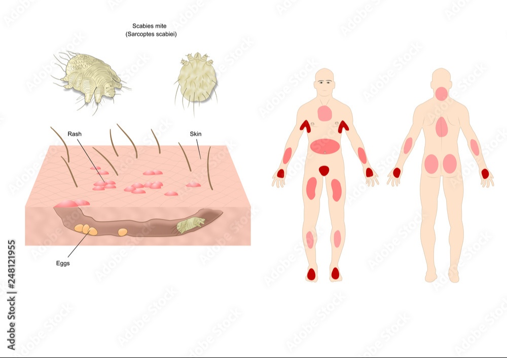 чесоточный клещ