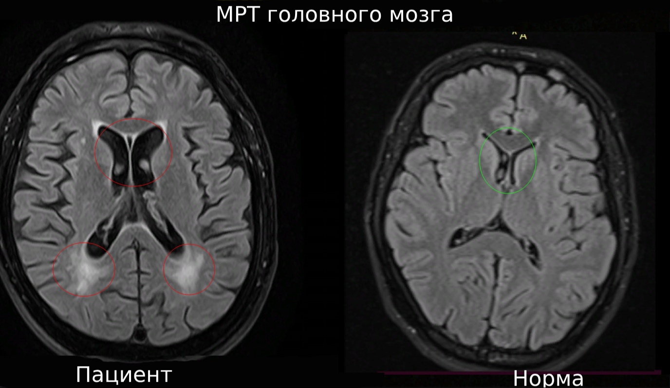 нейросифилис мрт