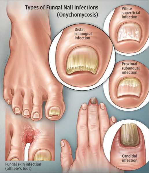 грибок ногтей